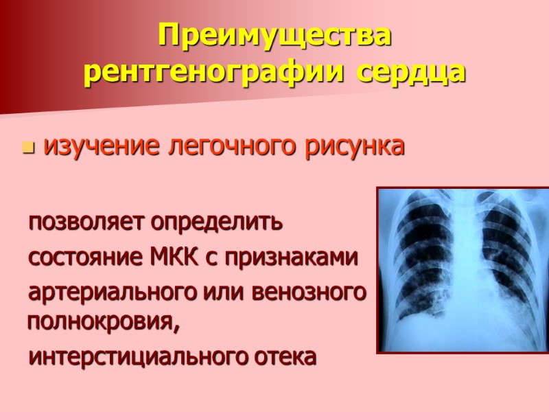 Преимущества рентгенографии сердца  изучение легочного рисунка   позволяет определить  состояние МКК